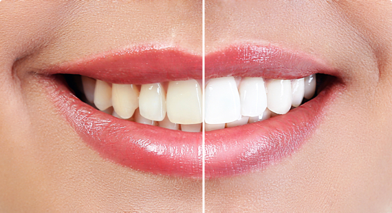 before and after teeth whitening